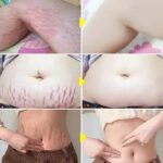 Continued Use of Abdominal Scar Removal Cream Eliminates Signs of Swelling, Repairs Cracks, Fades and Improves Fine Stretch Mark