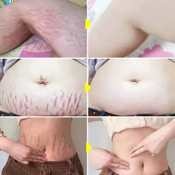 Continued Use of Abdominal Scar Removal Cream Eliminates Signs of Swelling, Repairs Cracks, Fades and Improves Fine Stretch Mark
