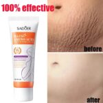 Continued Use of Abdominal Scar Removal Cream Eliminates Signs of Swelling, Repairs Cracks, Fades and Improves Fine Stretch Mark - Image 4