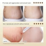 Continued Use of Abdominal Scar Removal Cream Eliminates Signs of Swelling, Repairs Cracks, Fades and Improves Fine Stretch Mark - Image 5