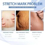 Continued Use of Abdominal Scar Removal Cream Eliminates Signs of Swelling, Repairs Cracks, Fades and Improves Fine Stretch Mark - Image 2